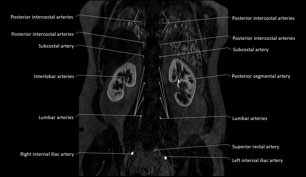 MRA Abdomen coronal anatomy image 43.webp